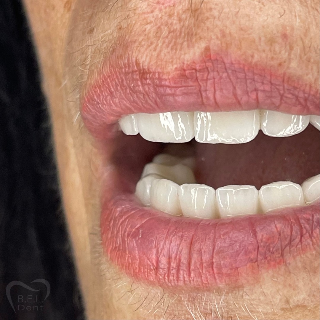 Ponte e corona in zirconia 